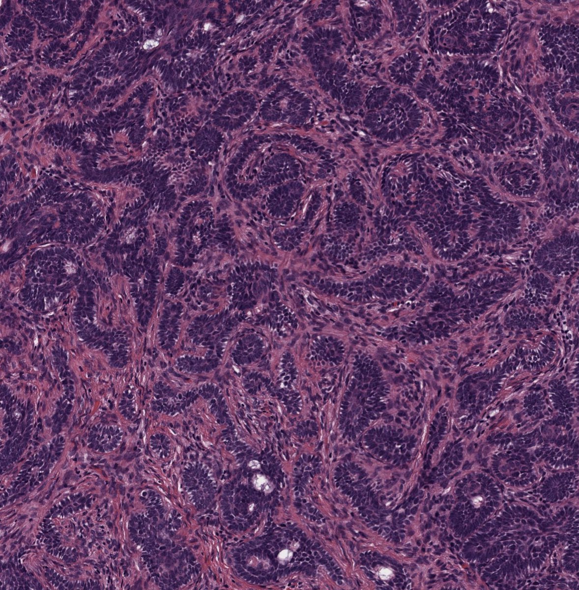 HENRYY_MD's tweet photo. Back to my previous topic again. You think it is pretty easy to separate sweat gland tumor from hair follicle tumor,  but sometimes it is not straight forward. Have this case from the https://t.co/a8z6Kn2hC6. No history. What is your impression? #dermpath https://t.co/ir8ZQhuraa