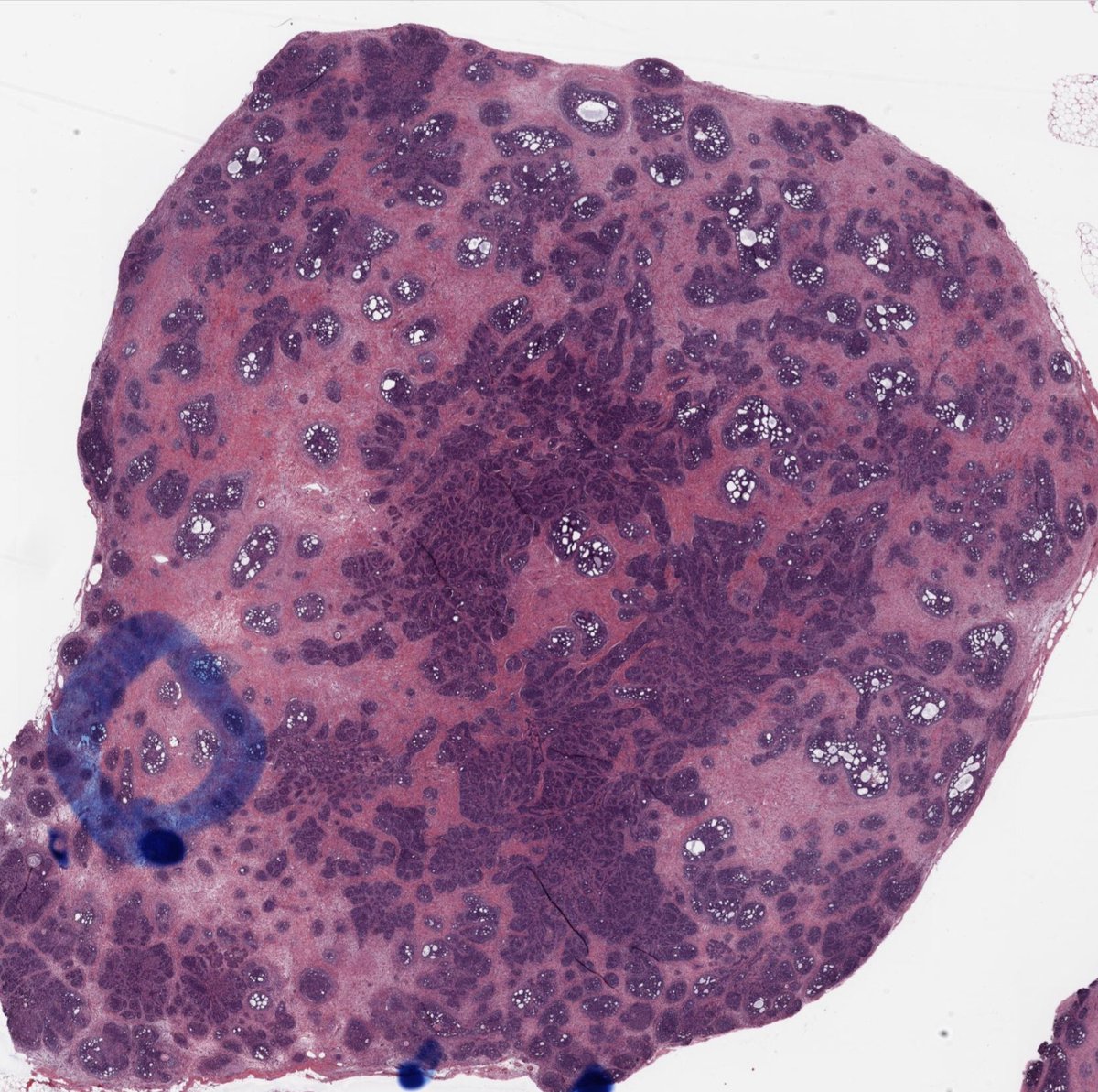 HENRYY_MD's tweet photo. Back to my previous topic again. You think it is pretty easy to separate sweat gland tumor from hair follicle tumor,  but sometimes it is not straight forward. Have this case from the https://t.co/a8z6Kn2hC6. No history. What is your impression? #dermpath https://t.co/ir8ZQhuraa