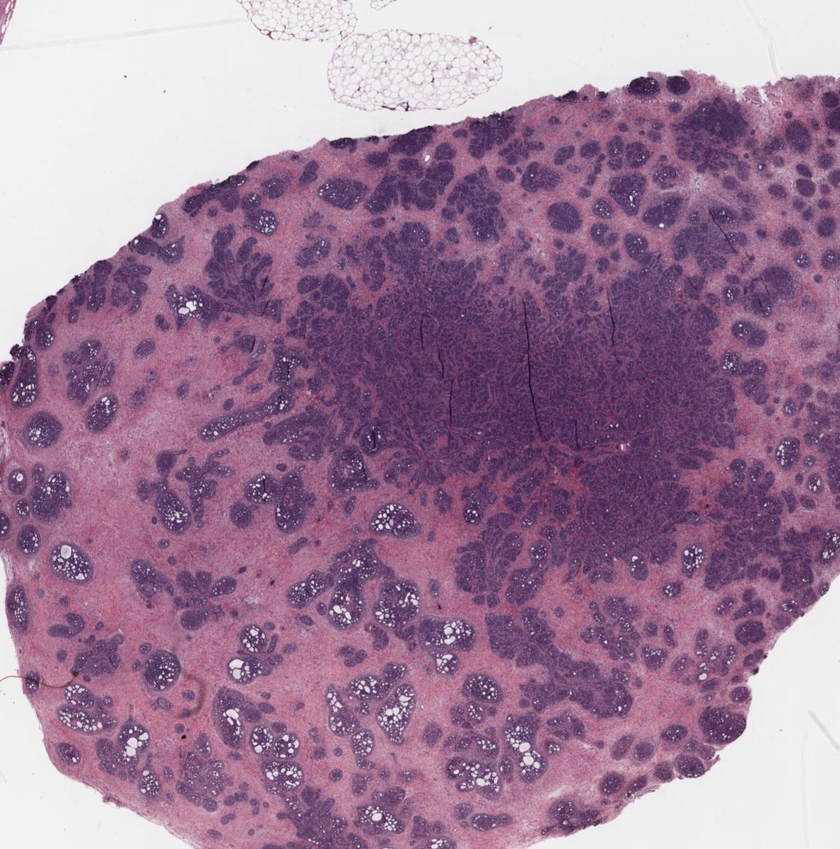 HENRYY_MD's tweet photo. Back to my previous topic again. You think it is pretty easy to separate sweat gland tumor from hair follicle tumor,  but sometimes it is not straight forward. Have this case from the https://t.co/a8z6Kn2hC6. No history. What is your impression? #dermpath https://t.co/ir8ZQhuraa