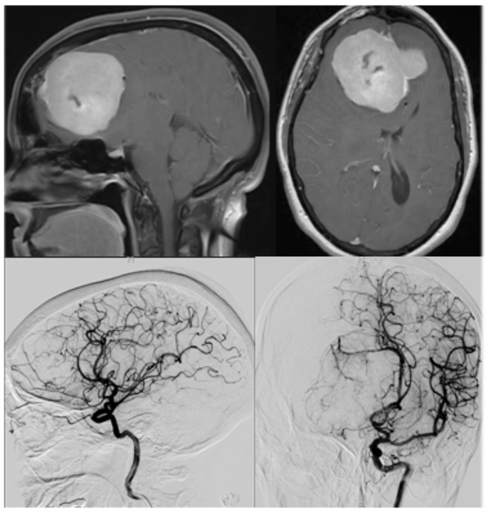 santiagodiana06's tweet photo. How could implant radiation help cure brain cancer?#RHSBMS #CuriosityQuestion https://t.co/j8E9KuhZ6N