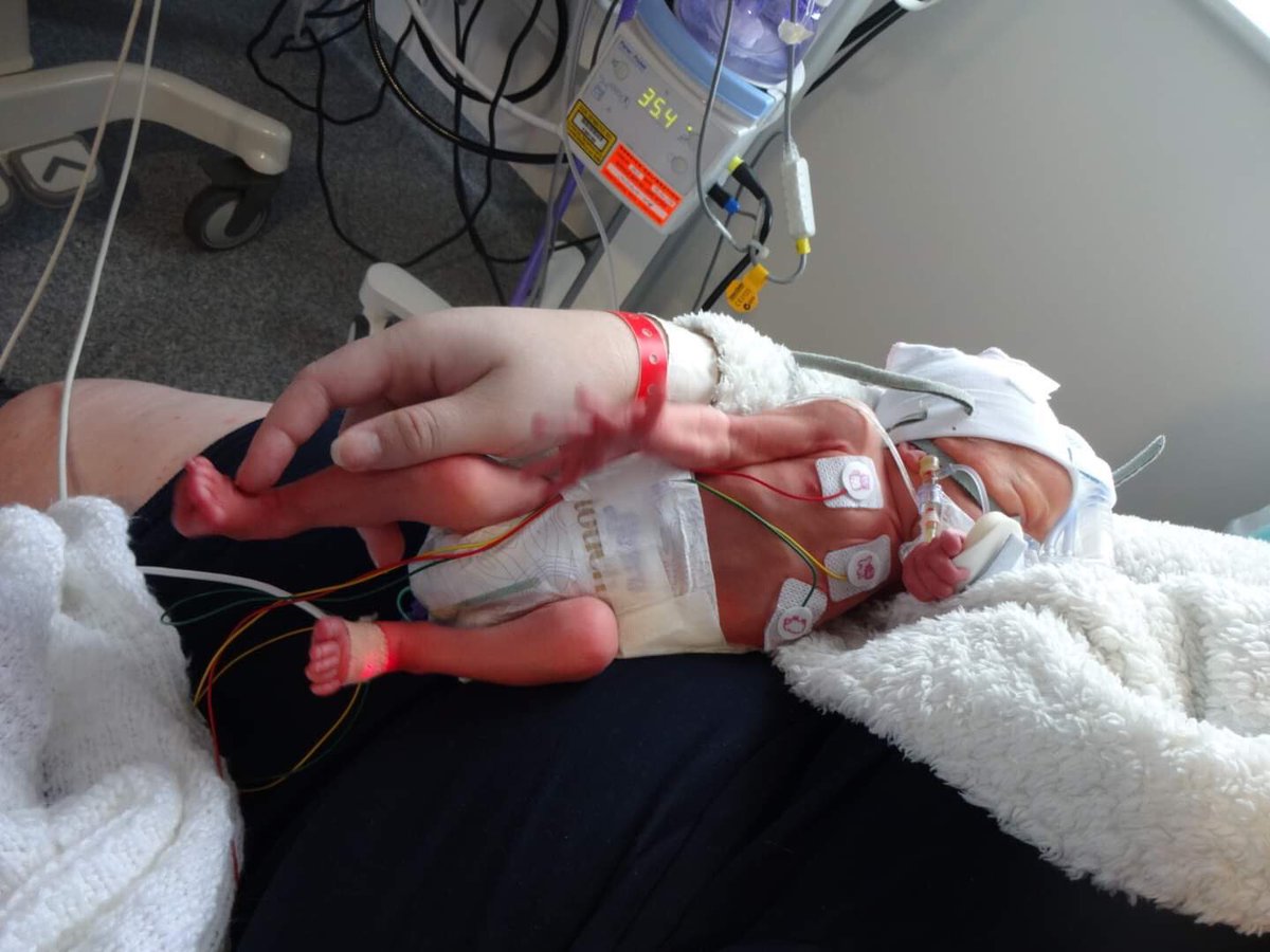 reunmoosmummy's tweet photo. I’ve not shared photos on here before, but this was my son at less than a day old. I can’t believe he was ever so tiny! #prematurebaby #32weeker #mysuperhero #amazingboy #nicu https://t.co/zEEKRI9PlP