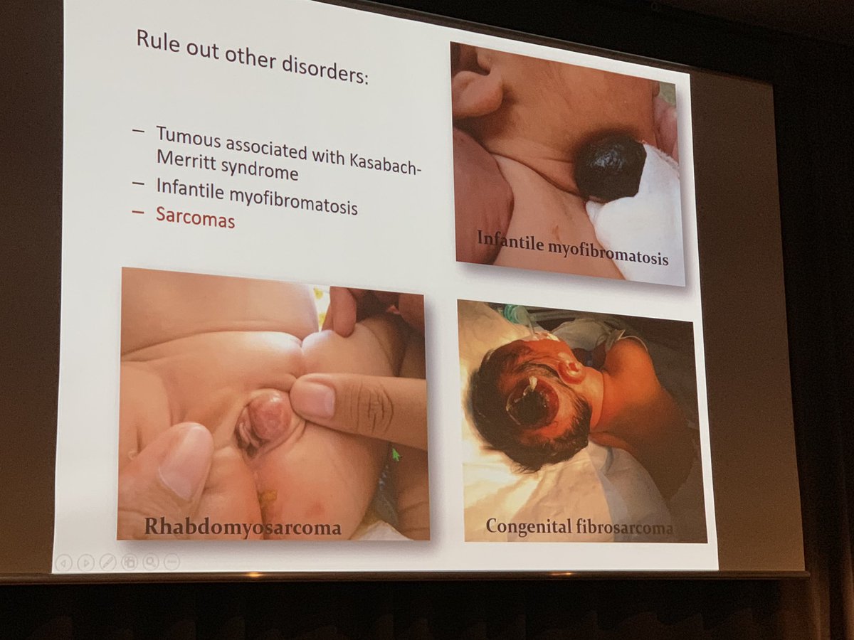 mreyesm's tweet photo. Excellent talk by Prof. Sylvie Fraitag at the #ECP2019Nice #PediPath session on vascular lesions. https://t.co/L0OJfbetwT