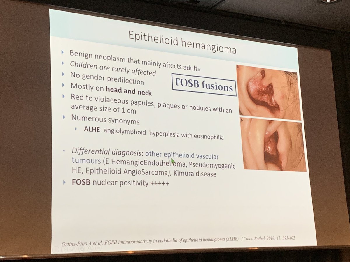 More on Prof. FRAITAG’s conference on #PediPath vascular lesions at the #ECPNice2019