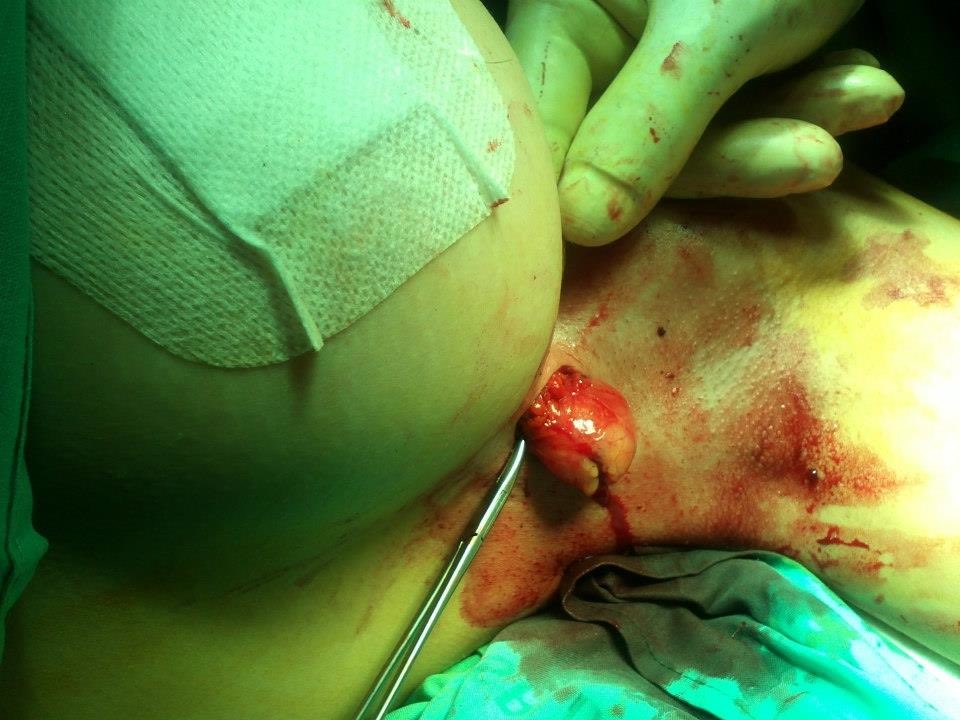 PIPActionA's tweet photo. “a large number of cases may have been missed because women suffering the symptoms of sudden, dramatic breast swelling +pain had their implants removed without them being tested for evidence of cancer cells.” @MattHancock @JustineGreening @SarahChampionMP 47,000 #PIPvictims https://t.co/Gnttu0Jqdk