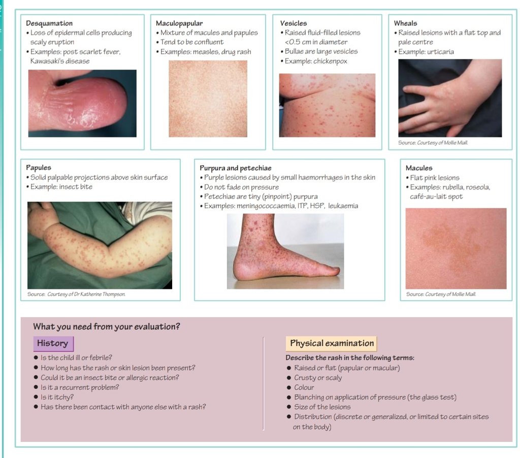 Cafe Au Lait Images Macular Rash