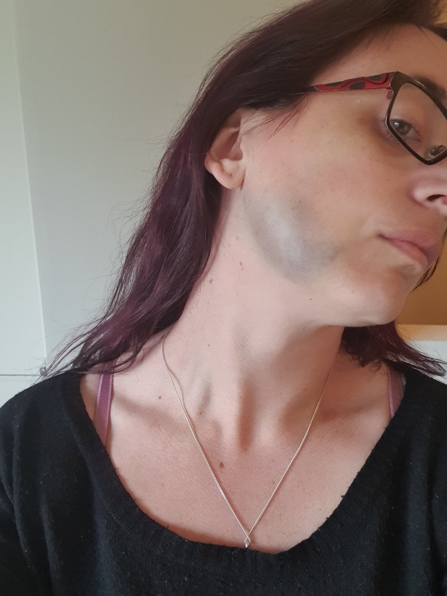 JulzBurgisser's tweet photo. So for my (very few) 'Jewels from NZ' podcast listeners. Here's the "What happened to your face?!" tweet that I promised. For the rest of you... you should probably listen for the explanation. 🤦♀️💙💜🤣
#bloodcondition #hereditary #bruises #ouch #hurtssogood #jewelsfromnz #mylife https://t.co/nCoMvWT8dx