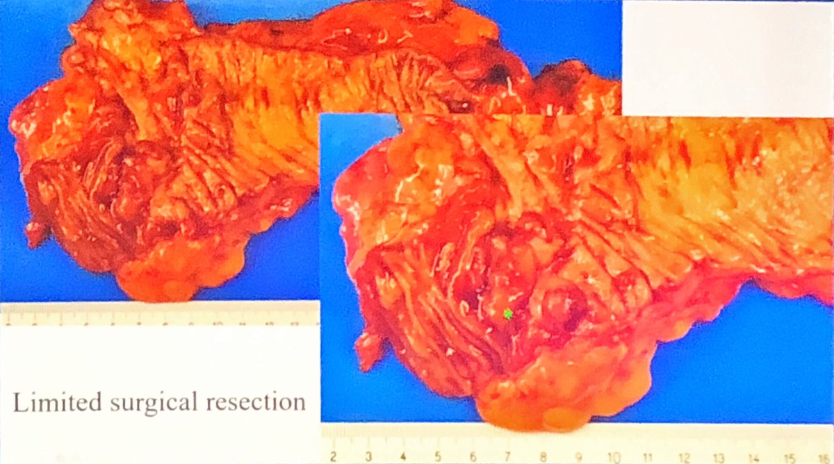 CamilleB_path's tweet photo. A facinating case of mass like caecum granulomatous colitis in a patient with past of Crohn’s disease
Do you have any idea ? ;)
By Gieri Cathomas
#ECP2019Nice #PathologyisNice #GIpath #infectiouspath https://t.co/FoT0zMVfRo