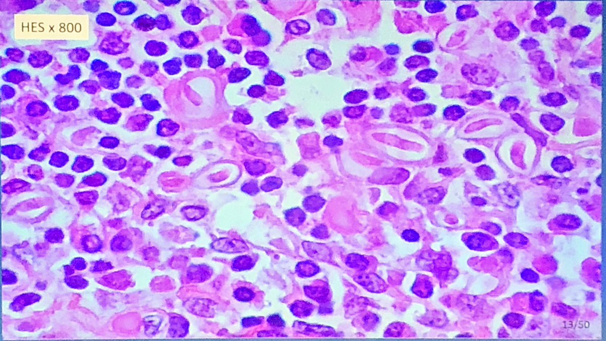 CamilleB_path's tweet photo. Infectious dissiminated lesions
Any idea ?
By Paul Hofman
#ECP2019Nice #PathologyisNice #GIpath #infectiouspath https://t.co/fEDGJ8V70y