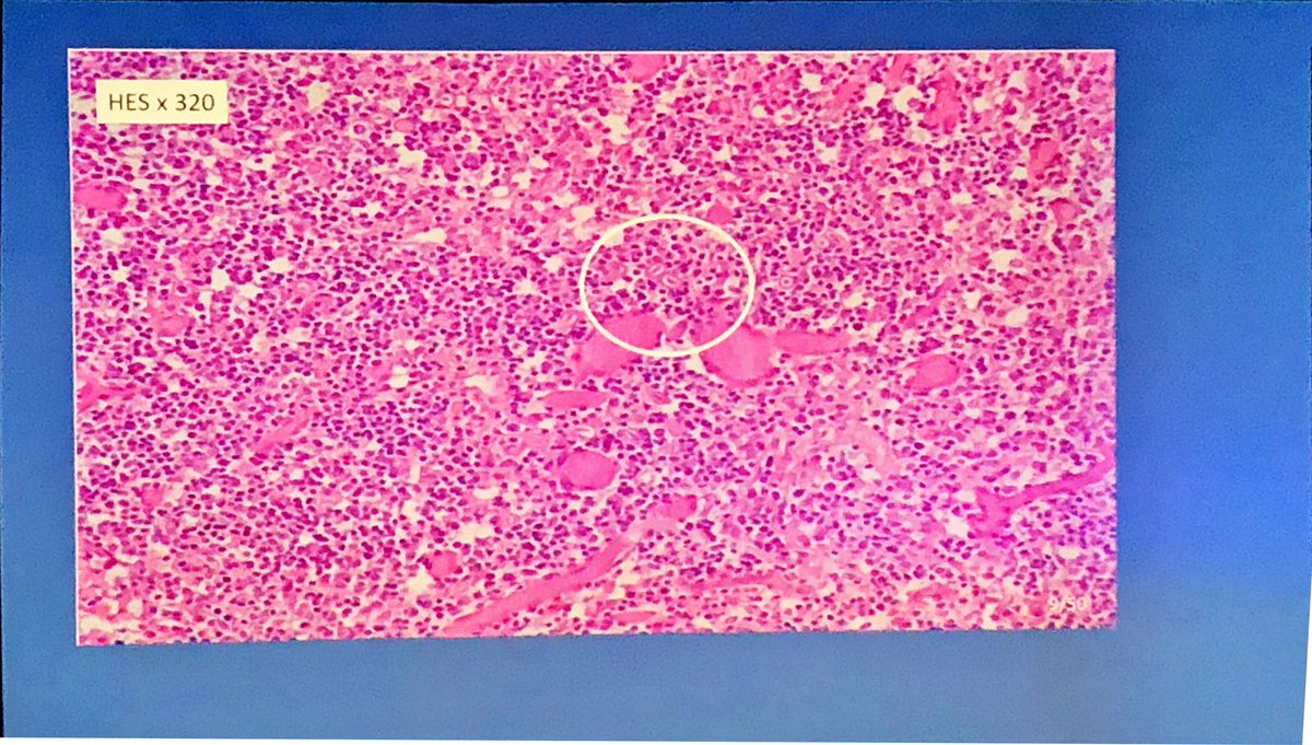 CamilleB_path's tweet photo. Infectious dissiminated lesions
Any idea ?
By Paul Hofman
#ECP2019Nice #PathologyisNice #GIpath #infectiouspath https://t.co/fEDGJ8V70y