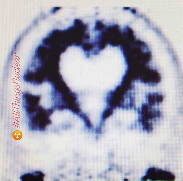 FlyntLesley's tweet photo. For those of us who have Nuclear Medicine in our hearts, and our hearts in our brains ❤️+🧠= ☢️ #nuclearmedicine #nucmed #allthingsnuclear #medicinanuclear #betaamyloid #betaamyloidimaging #alzheimersdisease #alzheimersassociation #amyvid https://t.co/hQ7kiEg5lM