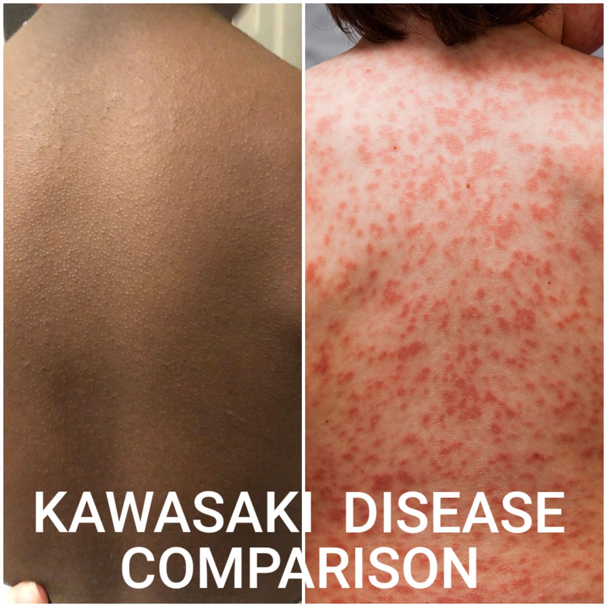 Folkeskole Overskæg rack Brown Skin Matters on Twitter: "This picture demonstrates how differently  the same disease can present on dark versus light skin. A user submitted  photograph of Kawasaki disease (left) versus the American Heart