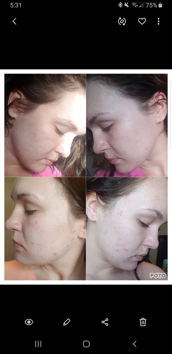 _kfeherrrr's tweet photo. @abbiii_ryan Curology. Free trail. My face went from this to this in 2 weeks https://t.co/gx7jyU4rHb