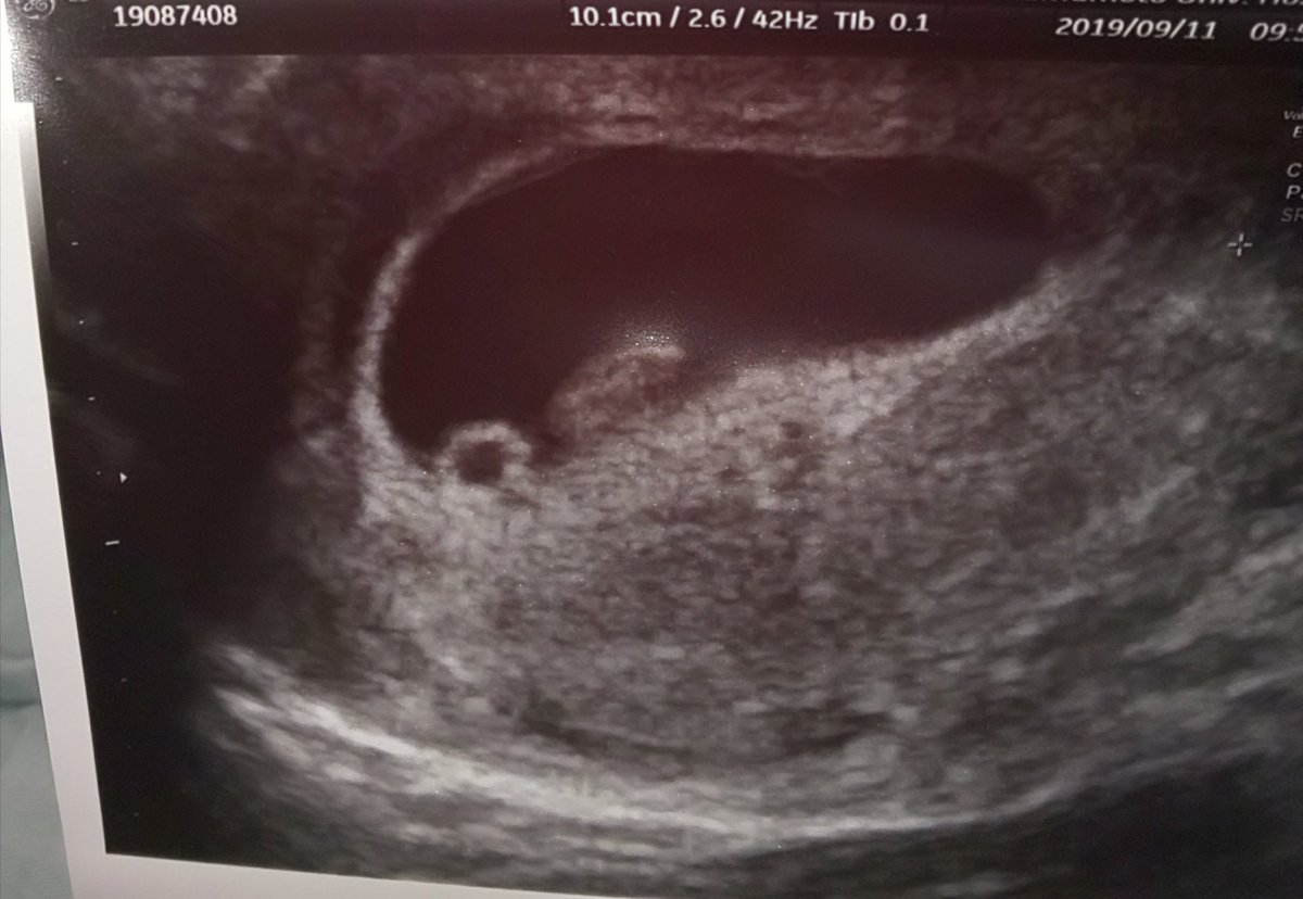 びわ子 1y 4 9 退院する前に9wも入ったし どうしても赤ちゃんに会いたくてお願いしてエコーしてもらいました 丸いのが頭で右の白い影が体みたい 心臓もちゃんと動いてた 無事が確認出来ただけで キッつい悪阻頑張れる気がする ってなる