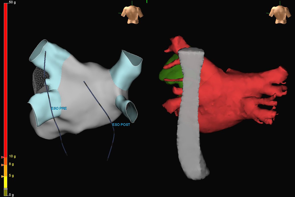 Most docs move mountains for their patients... EP’s are allergic to heavy lifting, but today we moved a patient’s esophagus in order to safely treat their  a.fib and avoid injuring the very, very, nearby esophagus #Afib #EsoSure #BurnTheHeartNotHeartBurn