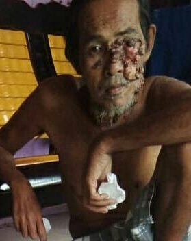 namanya Pak Mawardi, begitulah relawan kami menyebutkan. Sudah lama menderita kanker kulit. Kita bantu sembako yuks? BSM 709 9797 988 an Al Mumtaz Peduli, konfirm WA 085705608633 #SedekahSambas