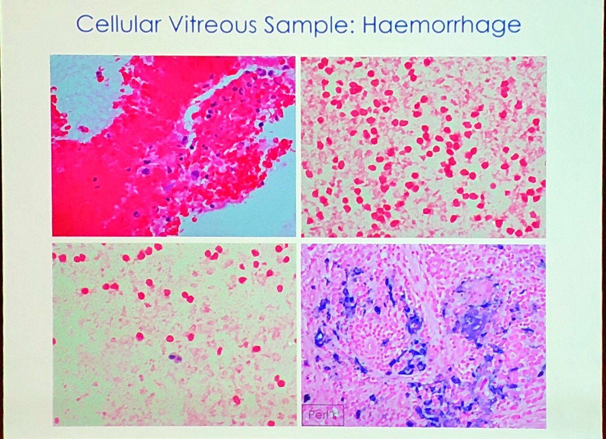 CamilleB_path's tweet photo. Uveitis cytology overview
1. The cellularity
2. The cells
3. Infectious agent? Eye or external material ?
Great presentation by
Sarah Coupland
#ECP2019Nice #PathologyisNice #Ophthalmopath #Eyepath https://t.co/EUW8BJTEM6