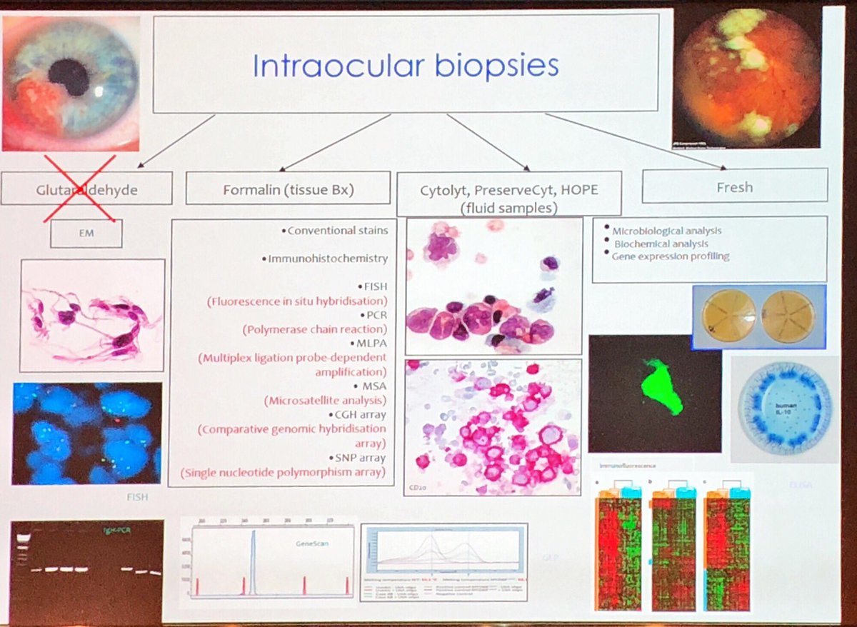 CamilleB_path's tweet photo. Uveitis cytology overview
1. The cellularity
2. The cells
3. Infectious agent? Eye or external material ?
Great presentation by
Sarah Coupland
#ECP2019Nice #PathologyisNice #Ophthalmopath #Eyepath https://t.co/EUW8BJTEM6