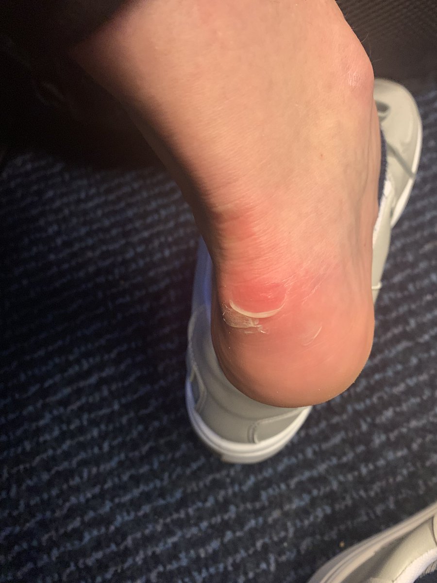 EHudson05's tweet photo. @ASOS_HeretoHelp really disappointed with the quality of my new ASOS design shoes - worn for 10 mins this morning and ripped my feet to shreds (both feet) can’t return now as they have blood in them. https://t.co/65ctbslraI