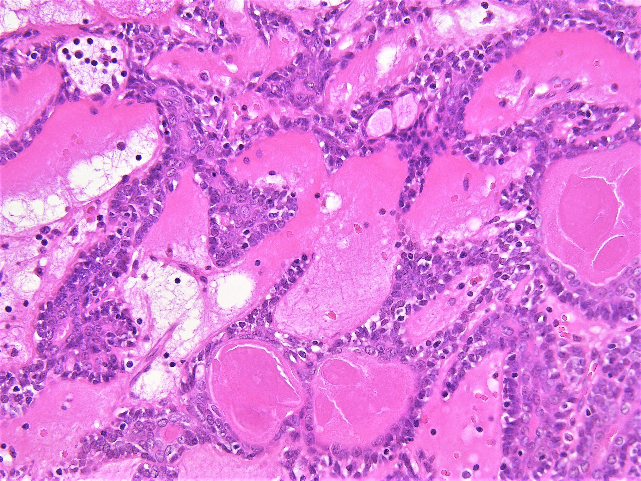 Pathology WalkerAuto Tweet Bot on Twitter "Spiradenoma. Skin of face