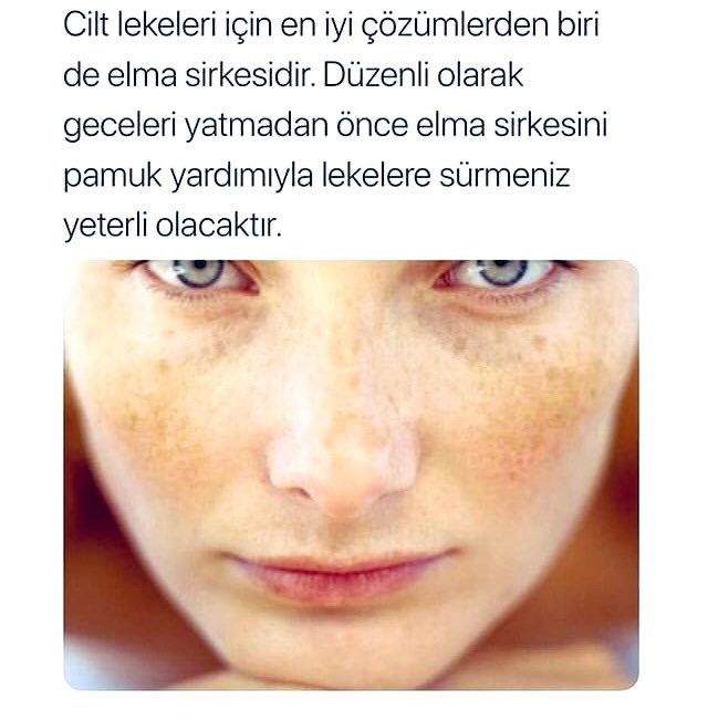 Yüzdeki lekeler için evde uygulayabileceğiniz doğal yöntem.