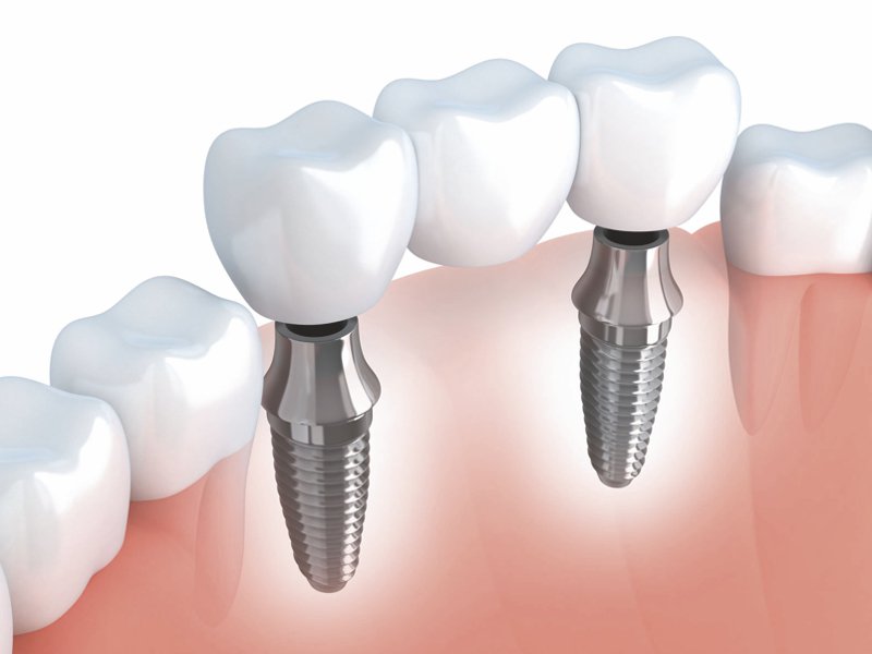 Missing teeth… What are your options? | There are many reasons for tooth loss. No matter what the reasons are, replacing your lost permanent tooth is important both for better function as well as appearance. ow.ly/LLBN30pvzql