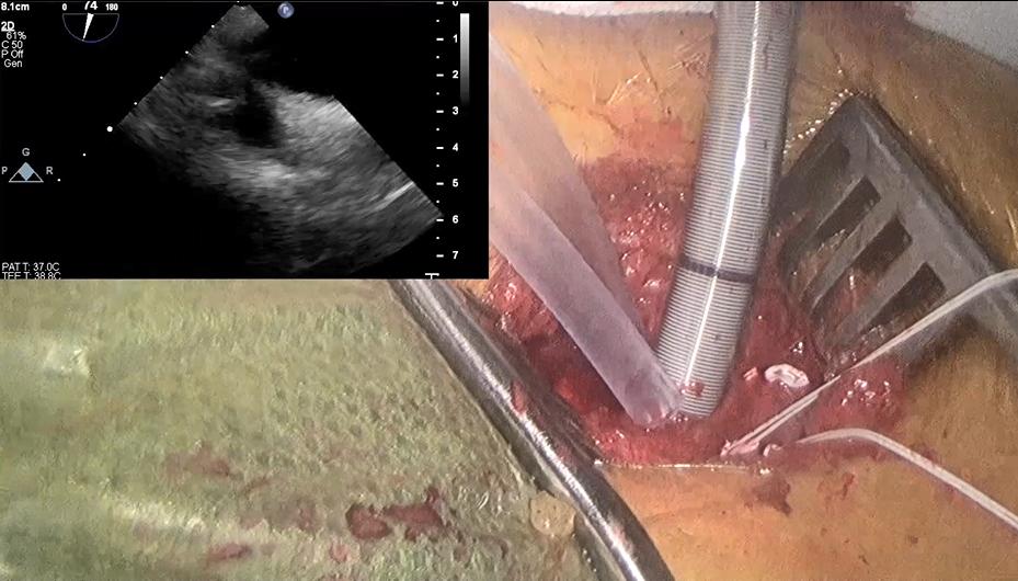 Isolated Endoscopic Tricuspid Valve Surgery bit.ly/2m4GBTb #tssmn #Cardiac #Tricuspid #Valve #Disease #MinimallyInvasive <a href="/ArieBlitzMD/">Arie Blitz, MD, MBA</a> <a href="/OuzounianMD/">Maral Ouzounian</a>