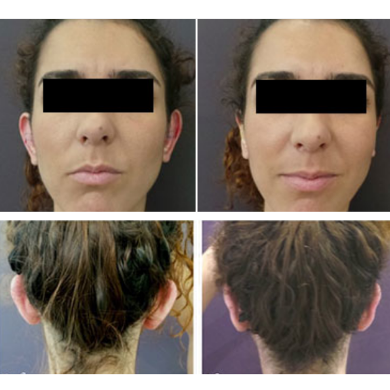 markhoasjoe's tweet photo. Ear correction surgery may help people who consider their ears to be too prominent, also the @Allergan earfold enhancer is a popular choice. Why not speak to us and book an consultation to discuss your options. #earcorrection #minorsurgery #cosmeticsurgery https://t.co/NpmOVyZE7l