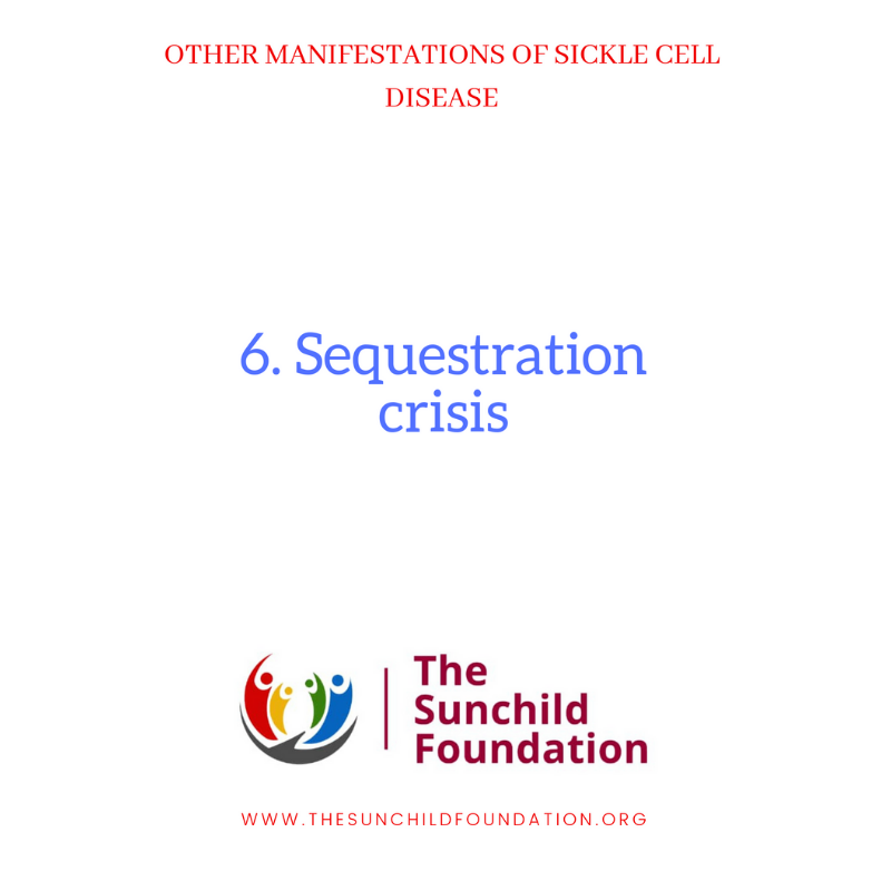 Sunchild_NG's tweet photo. OTHER MANIFESTATIONS OF SCD
No 6. Sequestration crisis:

 This is frequent in children with SCD.
 Blood pools in the spleen and/or liver.
 The spleen/liver enlarges quickly in a few days.
 There is also rapidly dropping blood levels.
 It is life-threatening. (Is any of them not?) https://t.co/NQOmgBp9tr