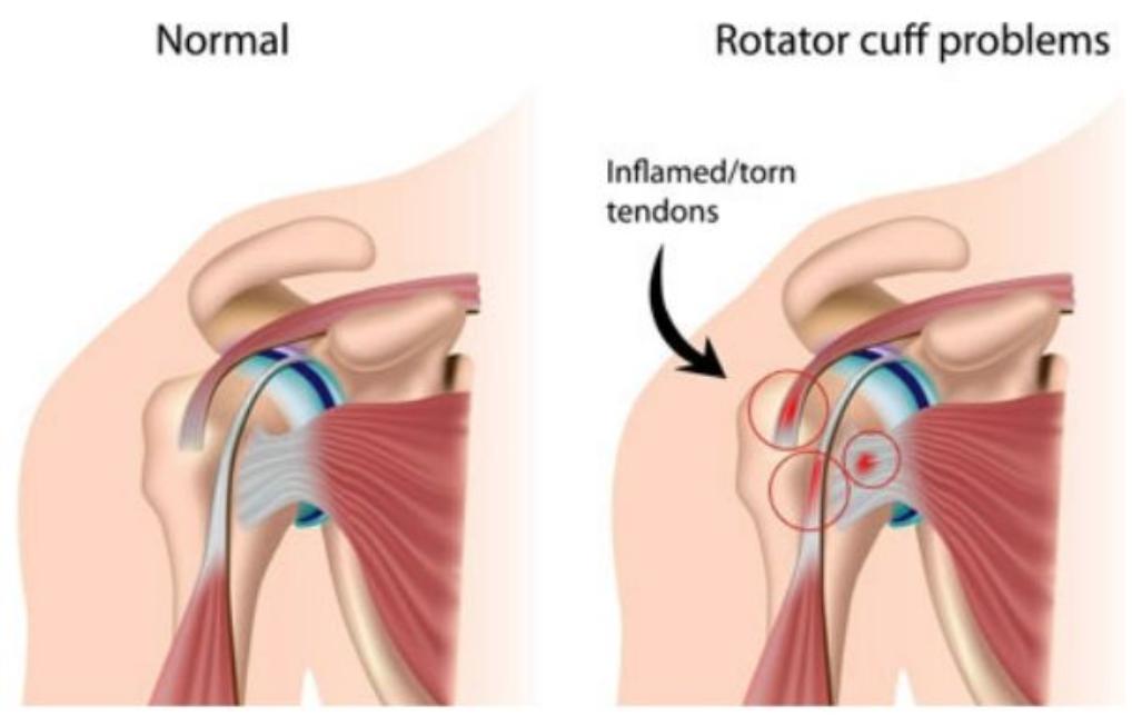Have you ever wondered what exactly causes a #RotatorCuffTear ? Here is your answer: medilink.us/zt8q