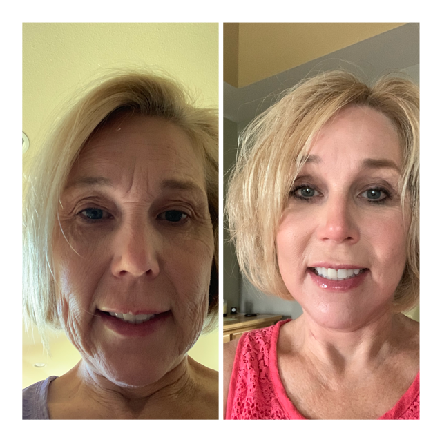 DrSPrendiville's tweet photo. Do you think a #Facelift is something drastically noticable and will make you look less like "you"? Take a look at this STUNNING Before and After from one of our beautiful clients who is just 2.5 months post Facelift and #EndoscopicBrowLift. #SWFLFacialExpert #beforeandafter https://t.co/yyoitC6wal