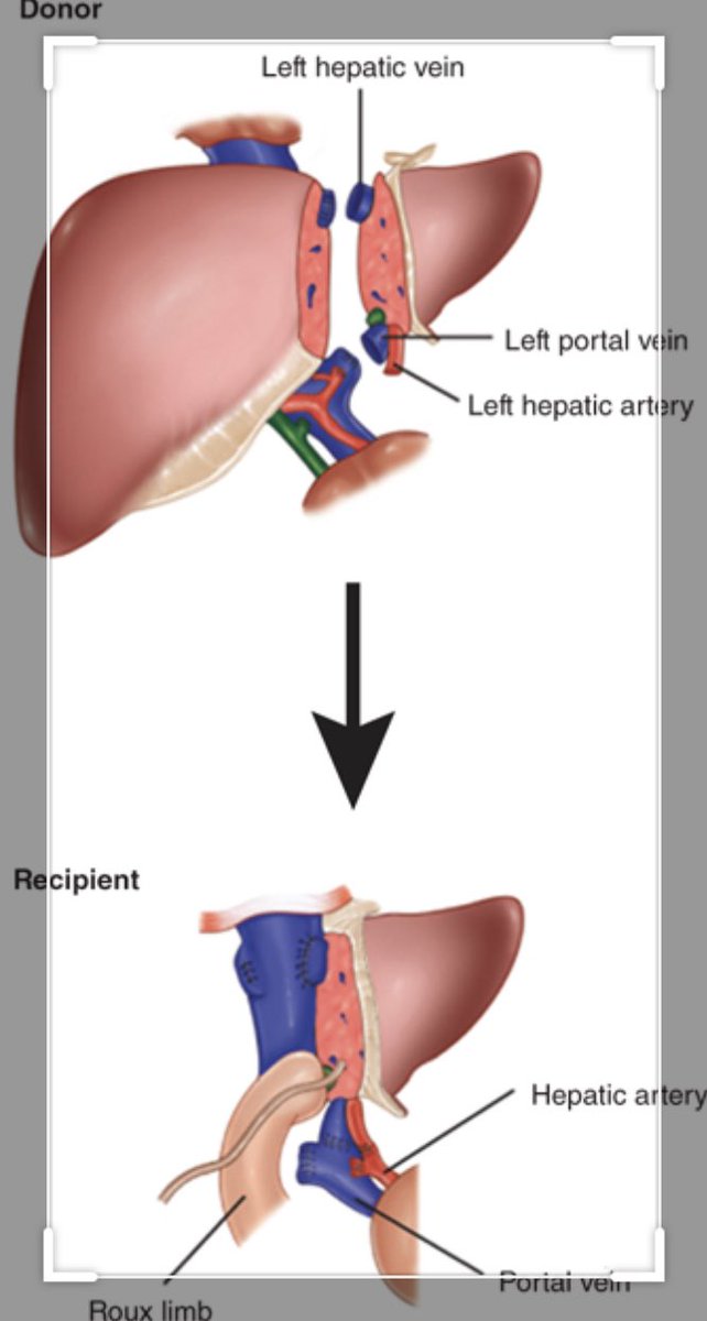 لمن يسأل عن مضاعفات  التبرع بالكبد للأطفال:
١-العمليه آمنه جدا  
٢-يؤخذ ١٠-٢٠٪من حجم الكبد 
٣-يعود الكبد للحجم الطبيعي بعد أسابيع قليله 
وهناك أطفال على قوائم الانتظار ،ينتظرونك أيها الشهم النبيل 
يعيش المتبرعين لوجه الله 
أجمل حياة بعد أجمل عطاء 
فالكبد هِي هِبَةُ الحياة 🙏🌸🙏