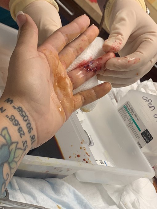 Yum, my stitches have stitches https://t.co/DHnS9oTmo9<a href="/tag/footworship"class="tags"><span>#footworship</span></a><a href="/tag/tickling"class="tags"><span>#tickling</span></a><a href="/tag/licking"class="tags"><span>#licking</span></a><a href="/tag/tickletortur"class="tags"><span>#tickletortur</span></a>