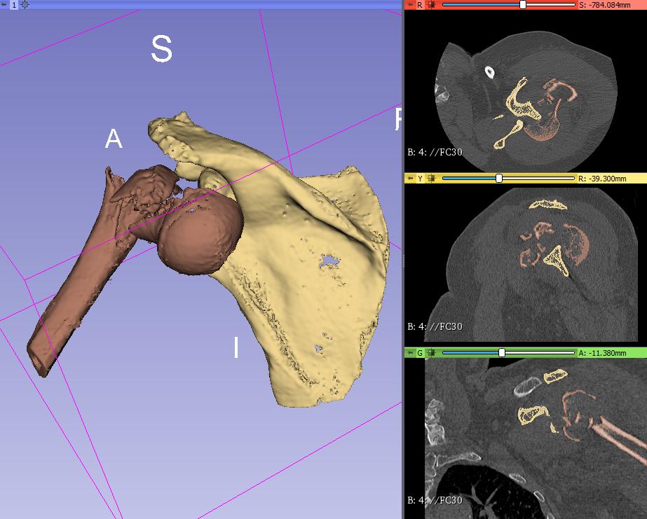 3d_maranon's tweet photo. This model shows a multifragmented fracture of the proximal end of the humerus. This case will be used for the 3D preoperative planning of the shoulder arthroplasty. 
Work by the Marañón FabLab Team: @rupermac @calvoharo_ja @diegotrap @LauraFloresBM @luciagds https://t.co/U9I511xxc5