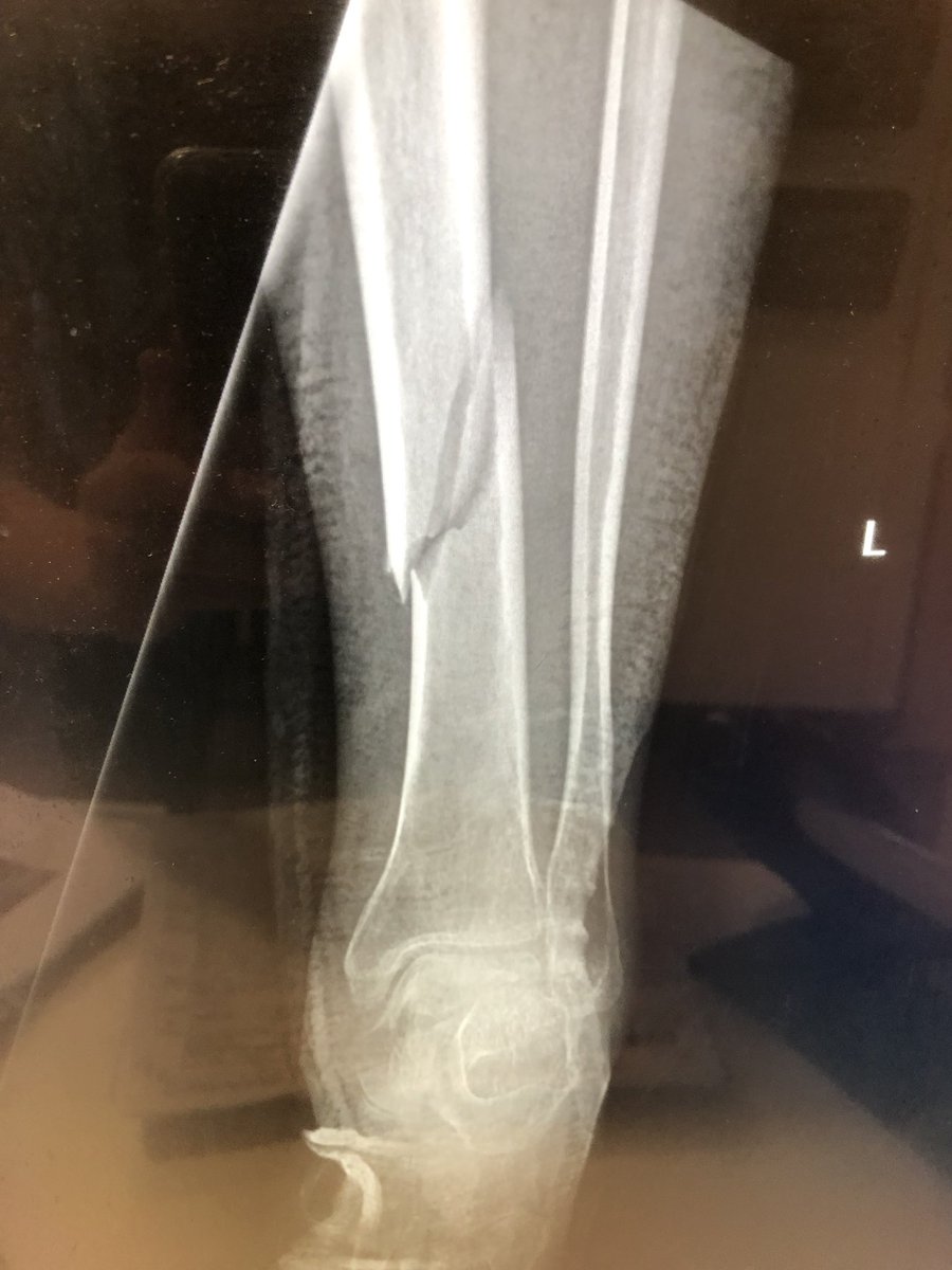 mmmhotwheels's tweet photo. If you miss me and wonder where I’ve been, this should sum it up.  I broke my leg about 3 weeks ago and had surgery. You’ll see me again soon. Miss you all. #brokentibia #surgery #fuckinghurts #missyou #cammodel https://t.co/QJfjRrtyuk