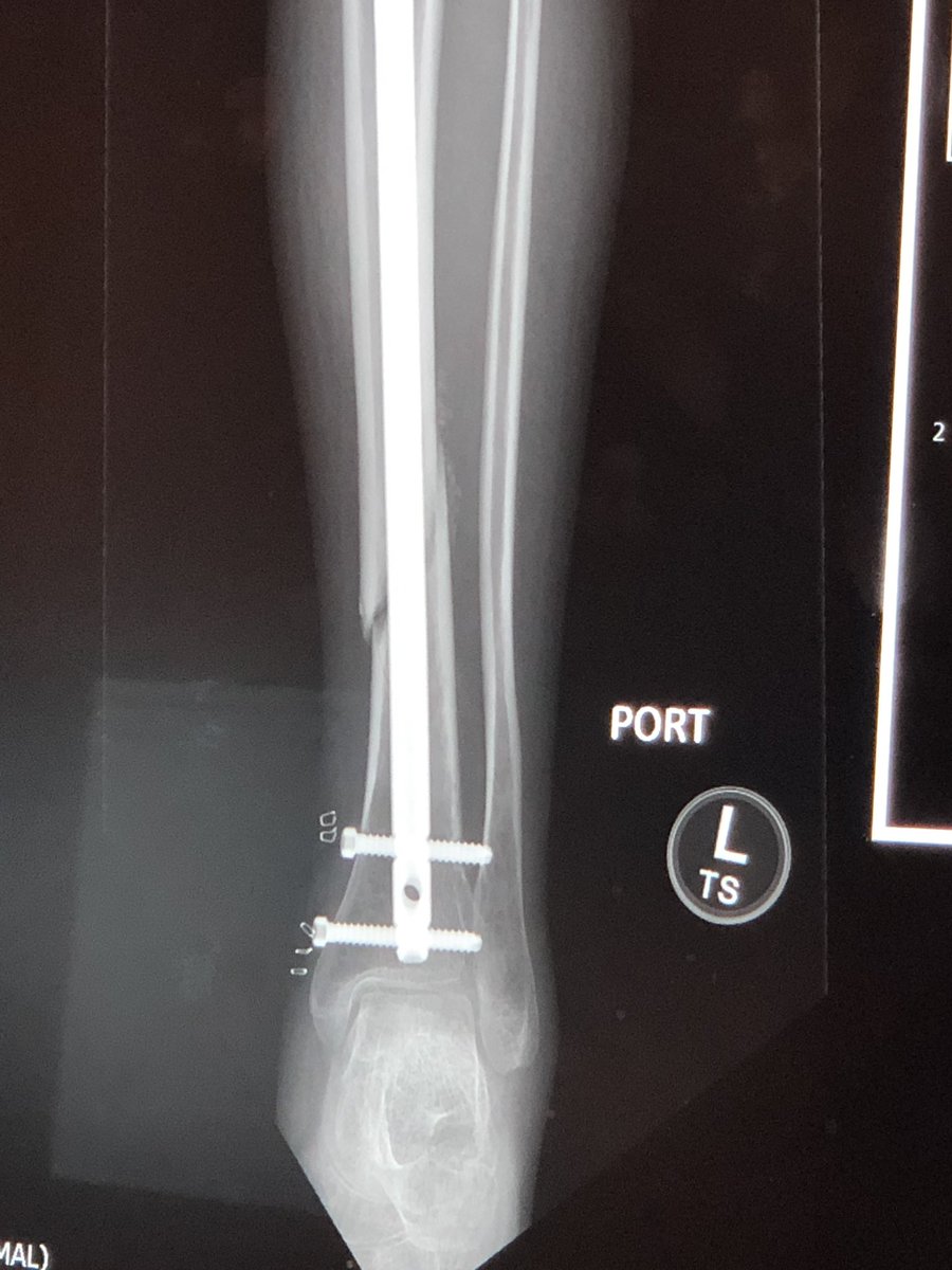 mmmhotwheels's tweet photo. If you miss me and wonder where I’ve been, this should sum it up.  I broke my leg about 3 weeks ago and had surgery. You’ll see me again soon. Miss you all. #brokentibia #surgery #fuckinghurts #missyou #cammodel https://t.co/QJfjRrtyuk