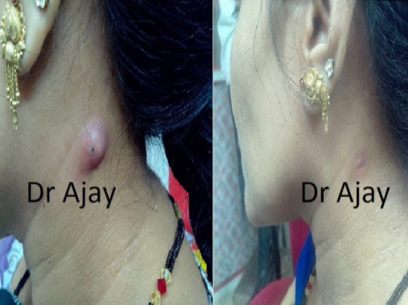HomeopathyPlus's tweet photo. Homeopathy for Abscess.
The symptoms always show which remedy is needed for a speedy resolution with homeopathy - throbbing, prickling or burning pain, watery or thick pus, colour of pus, and so on.
https://t.co/HGLfC2nsM1
#abscess #resolution #thickpus #burningpain https://t.co/aUM4Uq4iL5