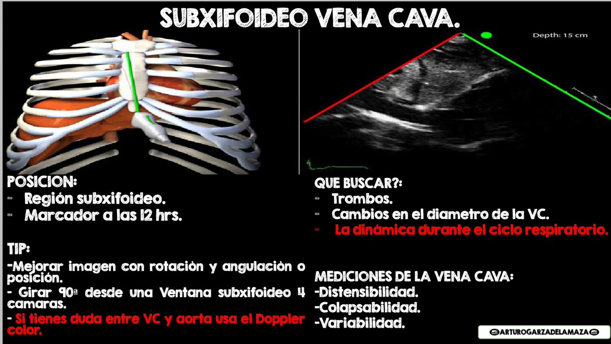 ArturoGDeLaMaza's tweet photo. VENTANAS DE ECOCARDIOGRAFIA.
-Subxifoideo Vena Cava-
" Lo es todo y nada " 
#FOAMed #FOAMex #FOAMcc #CriticalCare #ECOTT https://t.co/wTD6taL9JK