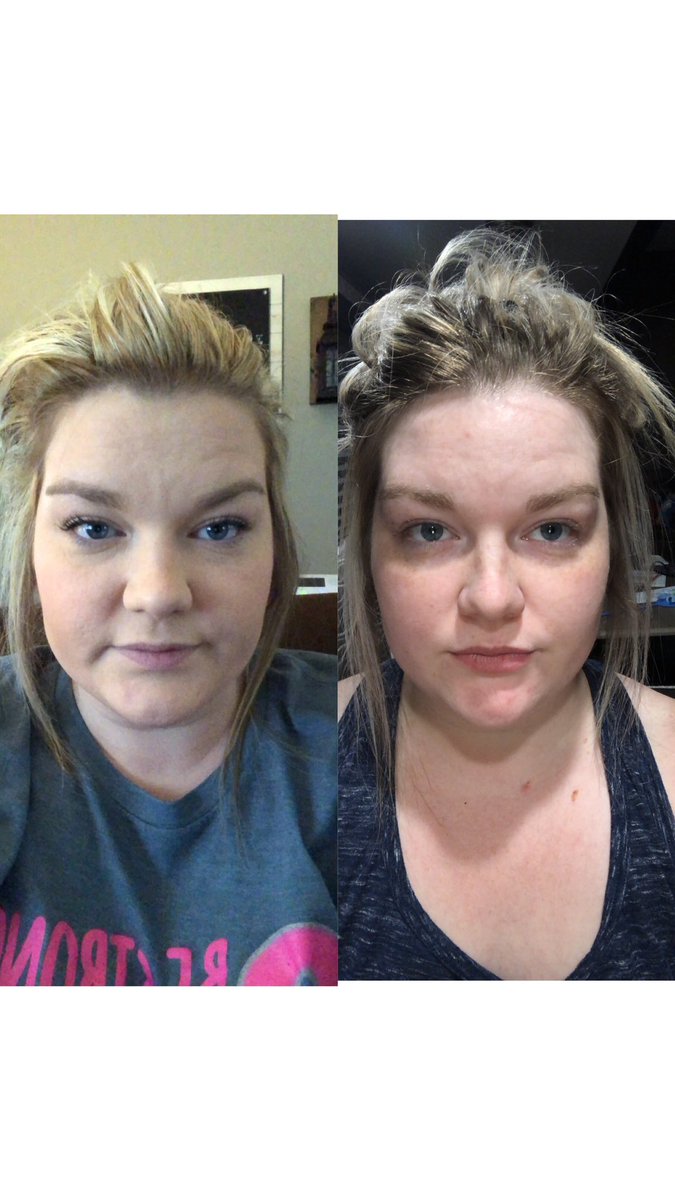 Ugly facial expression lol. But I wish I would’ve been paying attention to my #beforeandafters I can tell so much definition in my face compared to (left) just 3 months ago!! I’ve even lost the chipmunk cheeks around my mouth. #weightlossresults #nonscalevictory #FATTOFIT