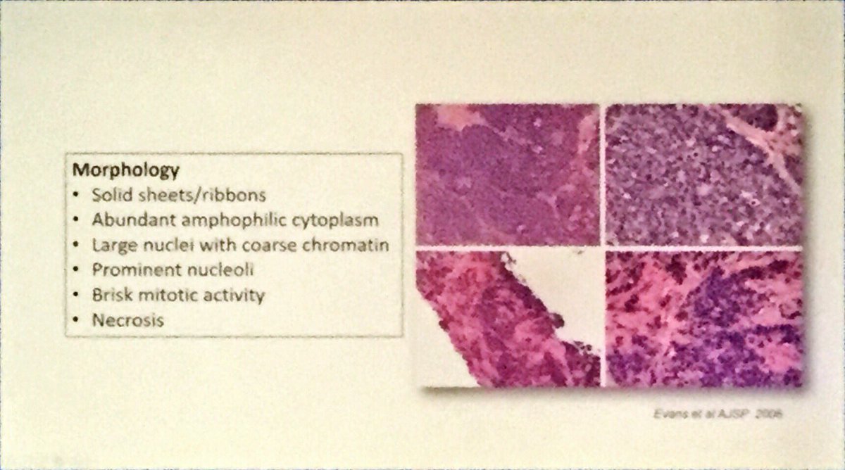 Large cell neuroendocrine carcinoma of prostate @DrNetto #GUPath #ECP2019Nice #ECPNice2019