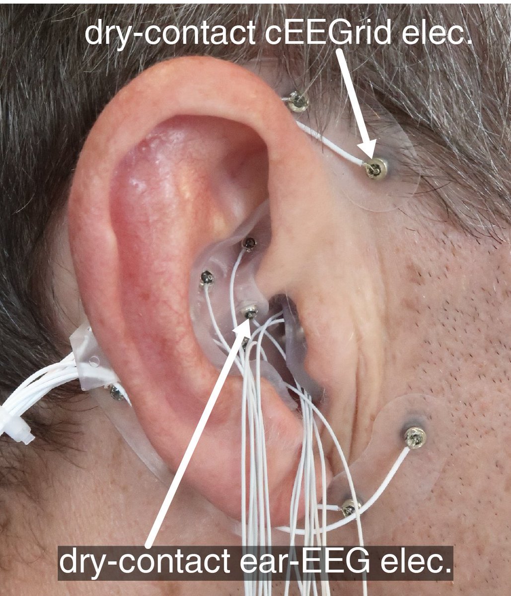 SimonLKappel's tweet photo. Our recent paper on ear-EEG forward models, is the first to present simultaneous recordings of high-density scalp EEG, dry-contact electrode cEEGrid, and high-density dry-contact electrode ear-EEG.
https://t.co/tqHpwldqSU

Dry-contact electrode paper: https://t.co/sI99R8aTC2 https://t.co/Qs2lPRAxZC