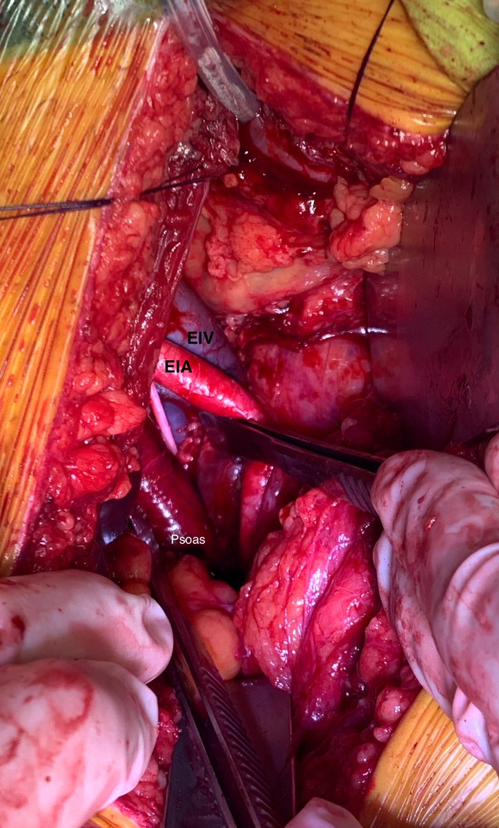 Matthew Winter (@matthewwinter01) on Twitter photo Fossa of Marseilles - one of my favourite anatomical areas in the pelvis. (Left Fossa of Marseilles) Top work <a href="/nelsonwang23/">Nelson Wang</a> Fossa of Marseilles - one of my favourite anatomical areas in the pelvis. (Left Fossa of Marseilles) Top work <a href="/nelsonwang23/">Nelson Wang</a>