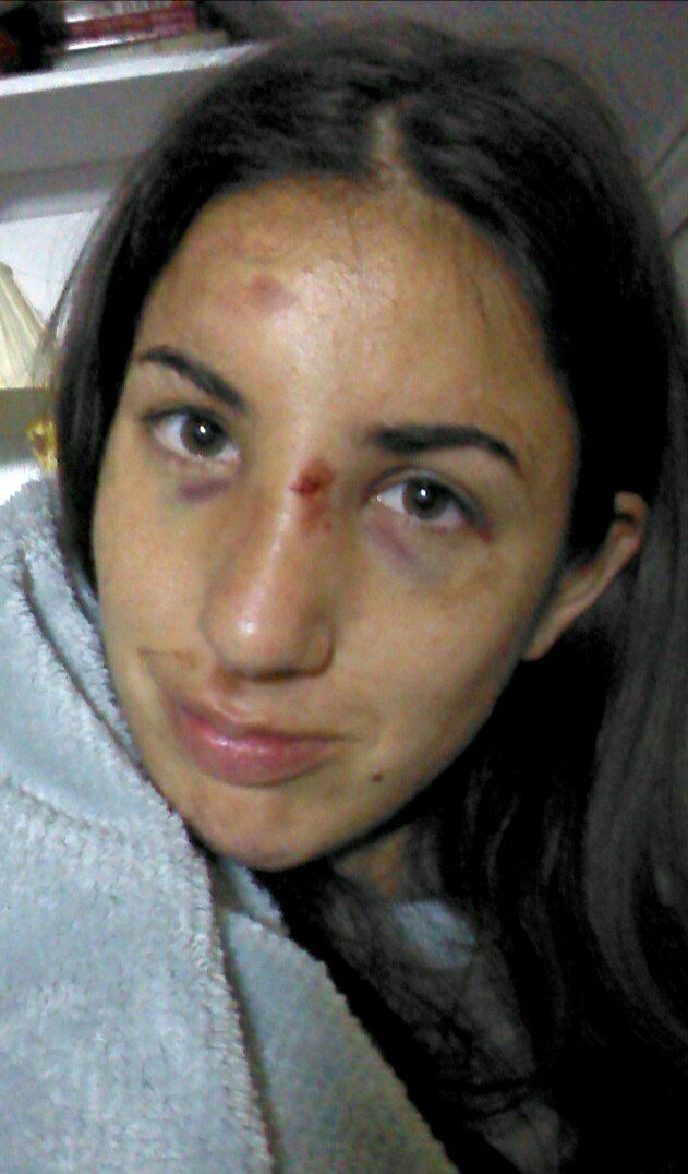 Had a fit and ruined my favourite jumper with my own blood. Epilepsy did it 😑 #epilepsy #epilepsywarrior #TommyHilfIger #purplewarrior #epilepsydidit #blackeyes #epilepsyawareness #bloodstained #epilepsyandme #FightOn  #fightepilepsy #theshowmustgoon #staypositive #epileptic