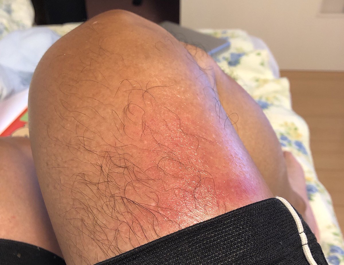 奈良のおとやん Twitterissa オヤジの足で申し訳ありません 火傷のようになったふともも たっぷりのメンソレータムでかなりマシになりました 真っ赤なとこは触ると痛いけど 昨日ほど触れたら痛いまでいきませんでした 左 右