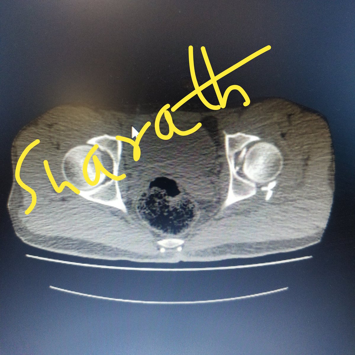 RamanathSharath's tweet photo. Posterior wall of acetabular fracture with free fragments in hip . trochanteric osteotomy ,anterior dislocation of hip to remove bone piece and Spring plate fixation of fracture. #acetabularfracture #pelvisfracture #complexfracture #orthopedics #hipsurgery. https://t.co/R25klI86Cu