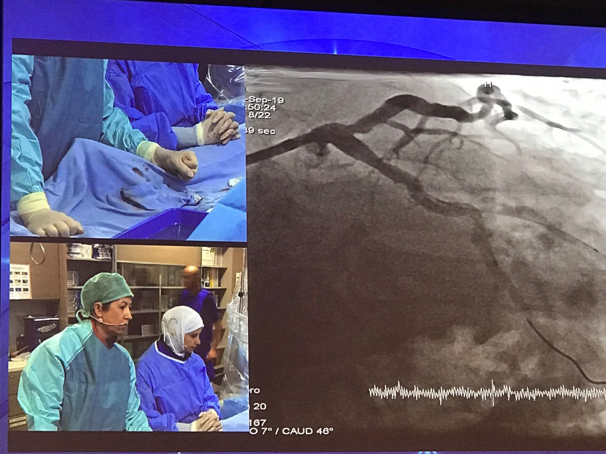 @mirvatalasnag and Kadriye Kilickesmez, MD tackle a complex bifurcation live case to open the SCAI MENATA Course in Istanbul, Turkey today. @scaiwin #SCAIWIN