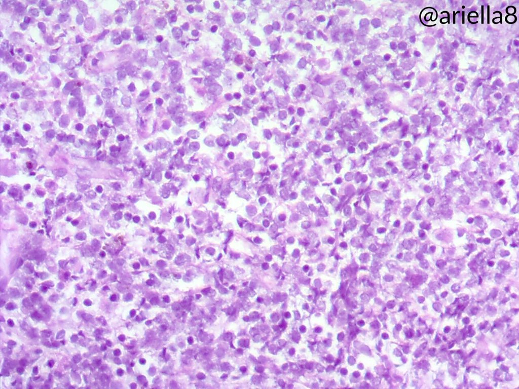 ariella8's tweet photo. #ENTPath #Pathcasetosolve #BSTPath A few more pics .Vocal cord tumor .Kindly share Your toughts 😊🙏 https://t.co/dmiEo0DsnJ