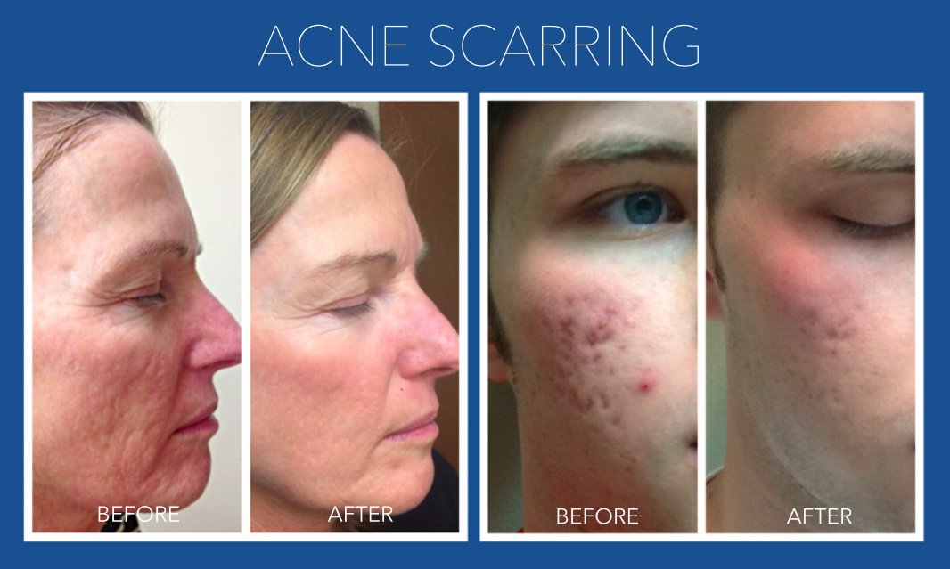 BeAjeless's tweet photo. #Microneedling with Rejuvapen is a remarkable, non-laser, non-surgical treatment that causes the skin to stimulate collagen production and fresh, new tissue. Skin tightens. Wrinkles, fine lines, scarring, and hyperpigmentation significantly diminish! https://t.co/lTT1XbpQCA