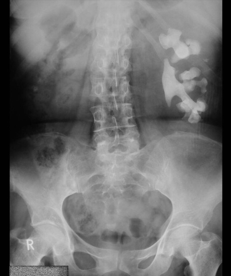 oegf98's tweet photo. ¿Que son los calculos coraliformes y a que se asocian? #RotUrg @joseatilionr 
Son calculos que ocupan toda o parte de la pelvis renal y se ramifican a un gran numero o todos los calices del riñon afectado. https://t.co/0y3BzUxiD6