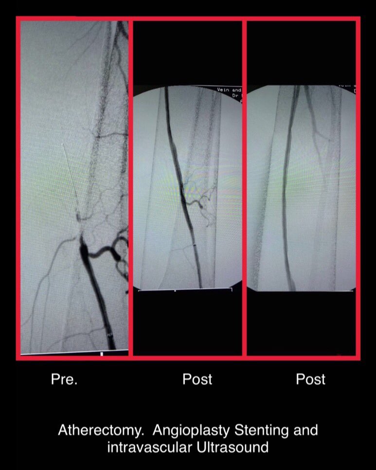 GotVeins's tweet photo. Left Femoral & Popliteal occlusion. Atherectomy, angioplasty & Stent placement w intravascular Ultrasound #vascularsurgery #endovascularsurgery #stent #angioplasty #athrectomy #ivus https://t.co/OnlIsMbTDD