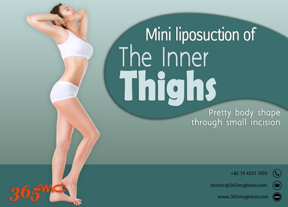 The fat stored in thighs is stubborn that doesn't go away despite dieting or exercising which can be removed easily & safely through #Mini_Liposuction of the #Inner_Thigh. Visit: snip.ly/erihh8 #innerthigh #liposuction #365mcglobal #miniliposuctionofinnerthigh #shape
